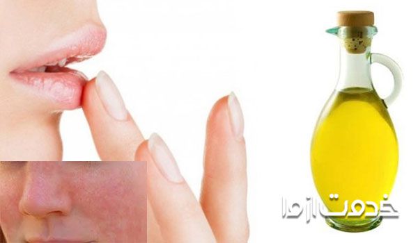 خواص روغن کرچک برای آفتاب سوختگی، قارچ بین پا؛ ترک خوردگی لب