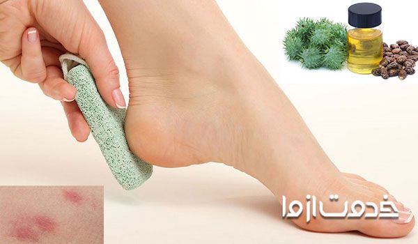 روغن کرچک و درمان التهاب پوستی و خارش و خشکی پاشنه پا