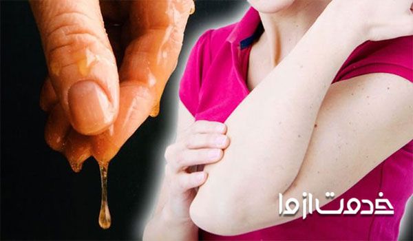 درمان خارش پوست با عسل