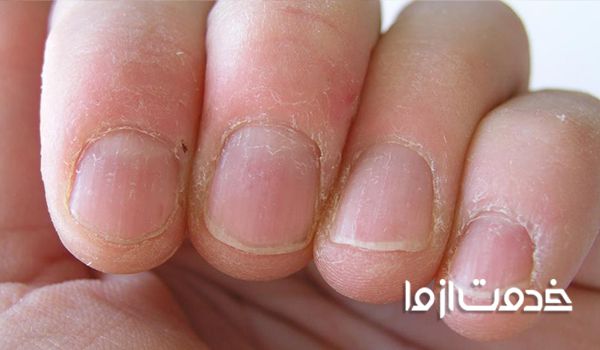 علت پوسته شدن اطراف ناخن چیست؟