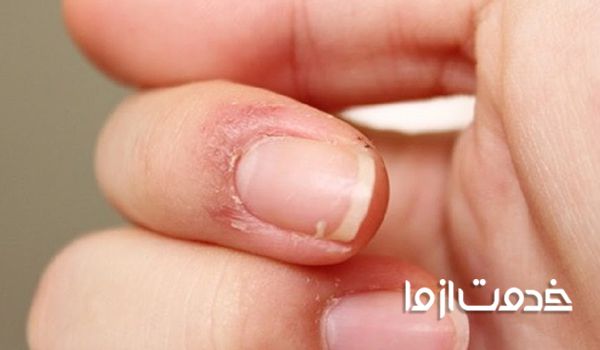 زخم شدن اطراف ناخن