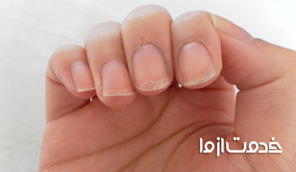 کمبود کدام ویتامین باعث پوسته شدن اطراف ناخن میشود