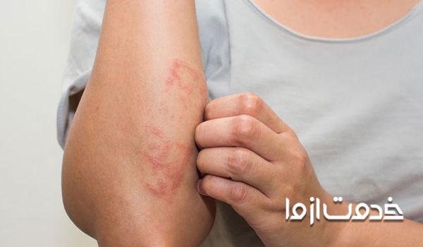 علت بیماری قارچ پوستی - دلایل بروز عارضه قارچ پوستی