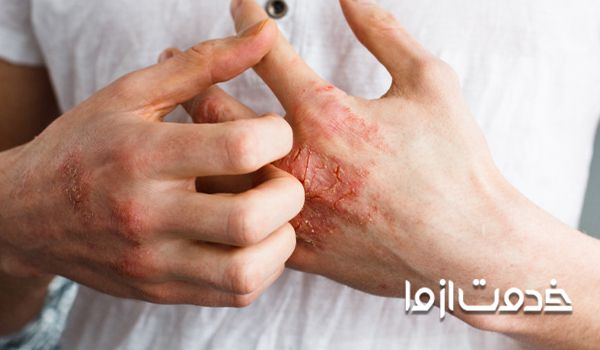 علت بیماری قارچ پوستی