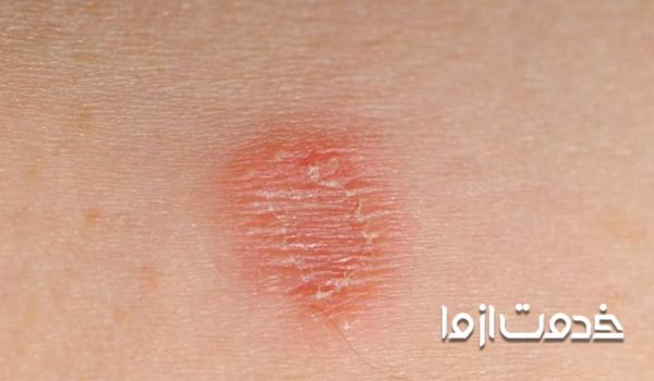 درمان بیماری قارچ  پوستی  - نکات پیشگیرانه در قارچ پوستی