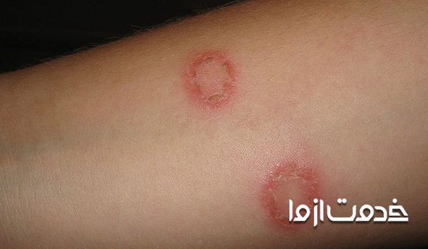 نکاتی برای پیشگیری و درمان قارچ حلقوی پوست