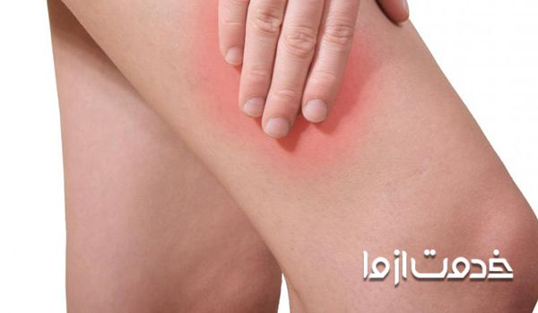 درمان قارچ پوستی کشاله ران