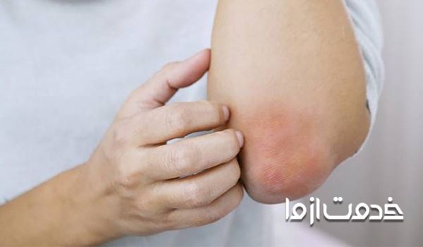 آیا قارچ پوستی واگیر دار است