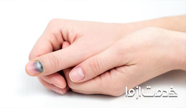 علت سیاه شدن زیر ناخن دست
