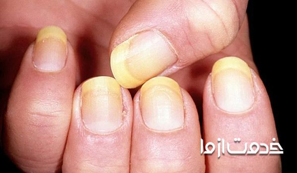 علت و راه درمان ناخن درد