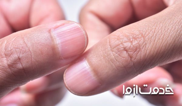 بیماری های ناخن همراه با عکس