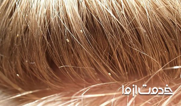 بهترین درمان خانگی شپش موی سر