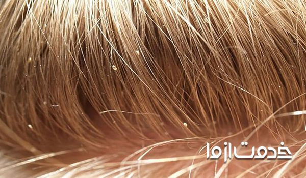 بهترین درمان خانگی شپش موی سر