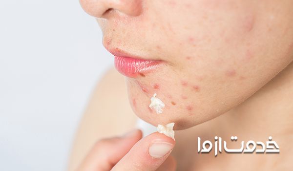 ۱۰ راهکار موثر درمان خانگی جوش صورت