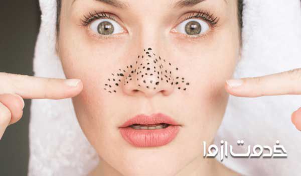 از بین بردن جوش‌های سر سیاه یکی از معضلات هر فرد است.