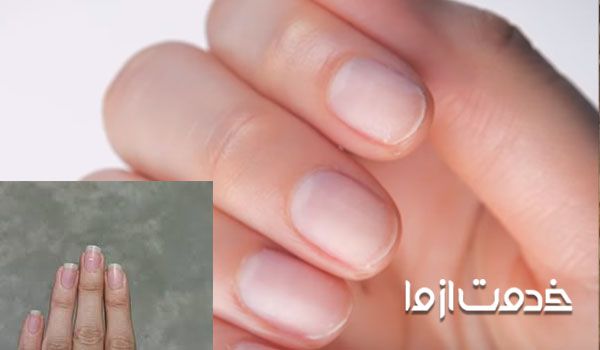 سفیدی روی ناخن به چه علت است؟