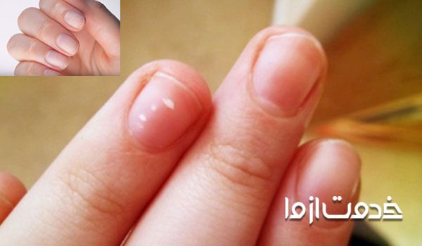 علت لکه سفید روی ناخن چیست؟ کمبود مواد معدنی