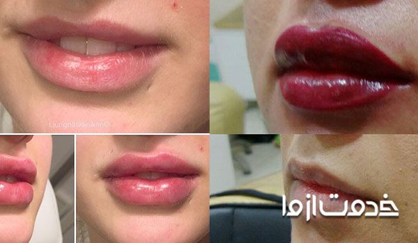 درمان ورم لب بعد از تاتو