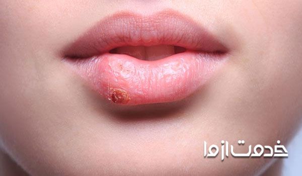 درمان تبخال بعد از تاتو لب