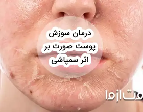 درمان سوزش پوست صورت بر اثر سمپاشی