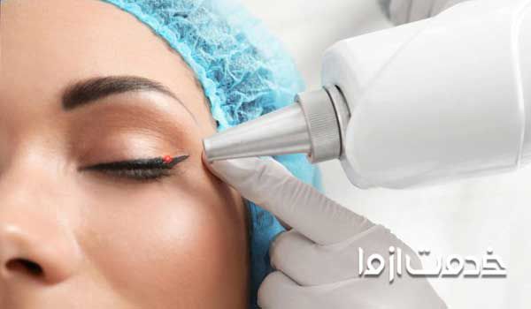 پاك كردن تاتو ابرو با ریموور با لیزر