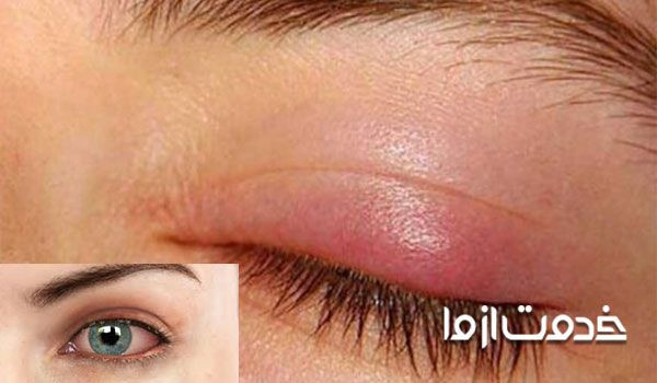 عوارض لیفت مژه چیست؟