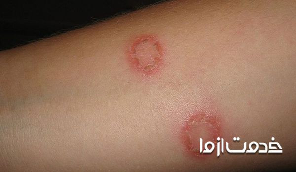 نکاتی برای پیشگیری و درمان قارچ حلقوی پوست