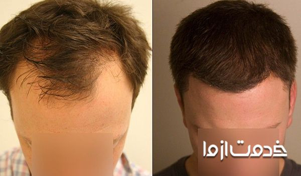 ترمیم موی سر به روش HRT