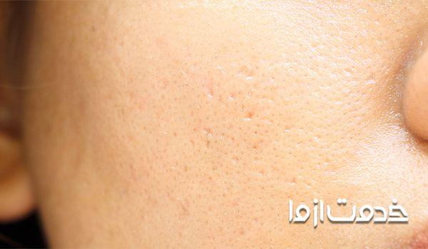 راهکارهای مفید برای بستن منافذ پوست صورت