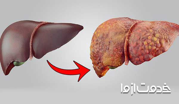 کبد چرب گرید 3 رژیم غذایی کبد چرب عوارض کبد چرب روی پوست